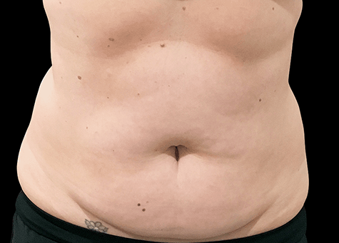 AA sculpsure after