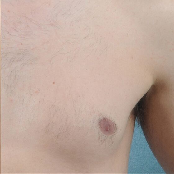 After-Vectus